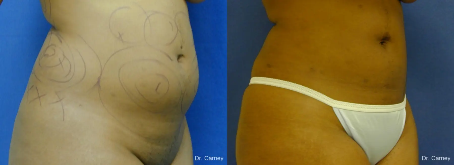 Virginia Beach Liposuction 1283 - Before and After 4