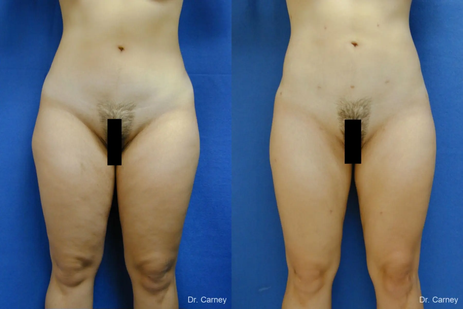 Virginia Beach Liposuction 1285 - Before and After 2