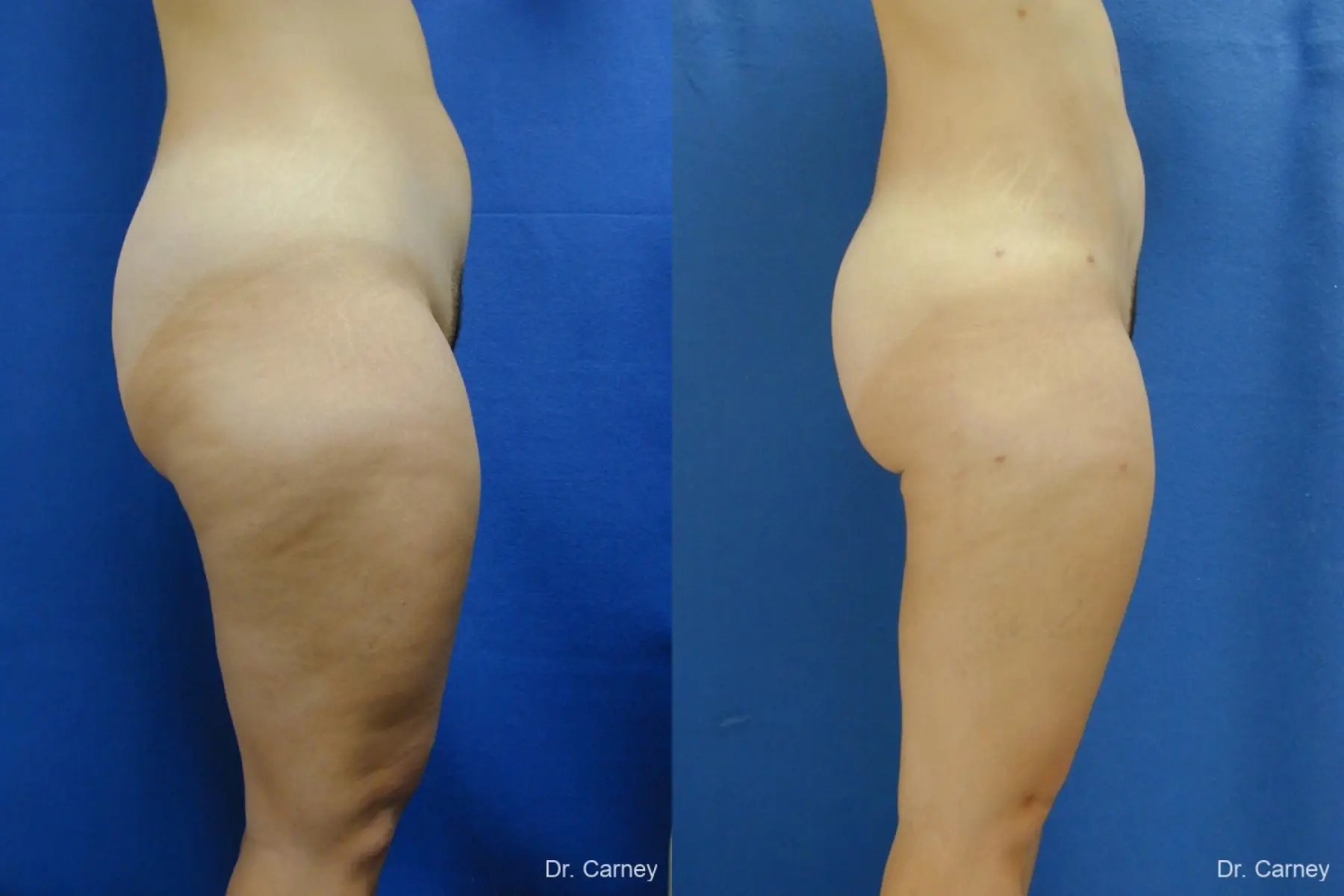 Virginia Beach Liposuction 1285 - Before and After 4