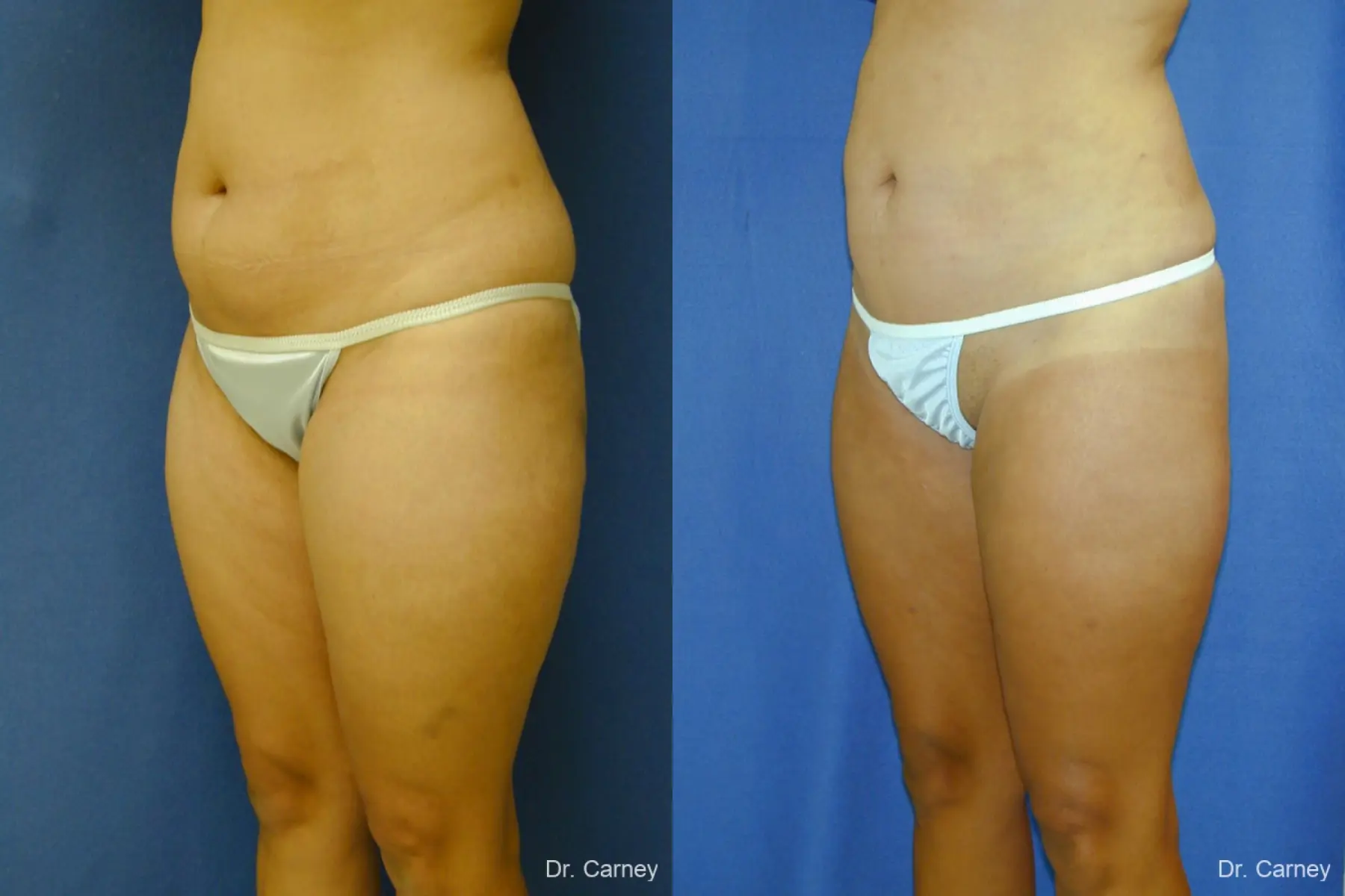 Virginia Beach Liposuction 1284 - Before and After 2