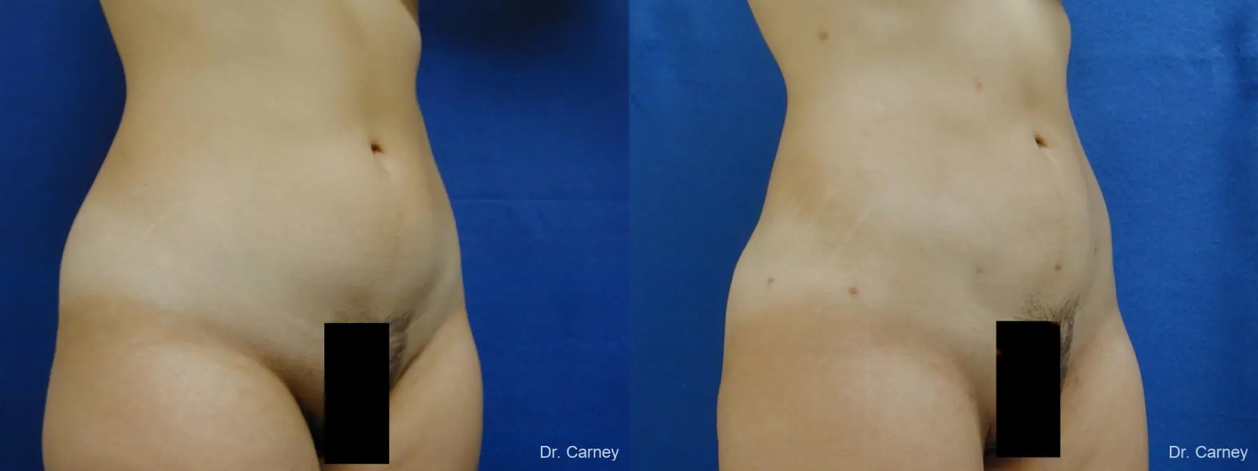 Virginia Beach Liposuction 1276 - Before and After 2