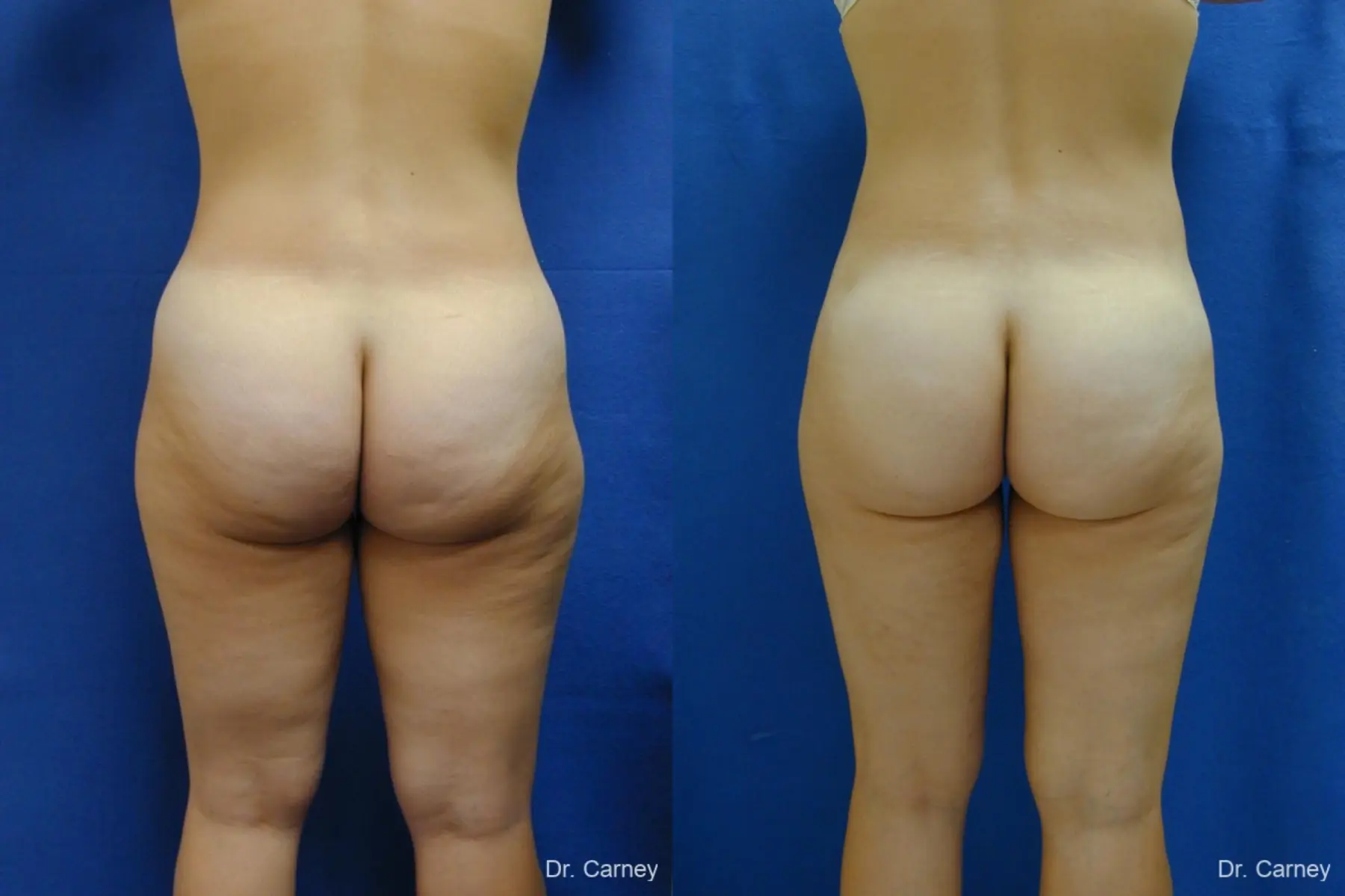Virginia Beach Liposuction 1285 - Before and After 5