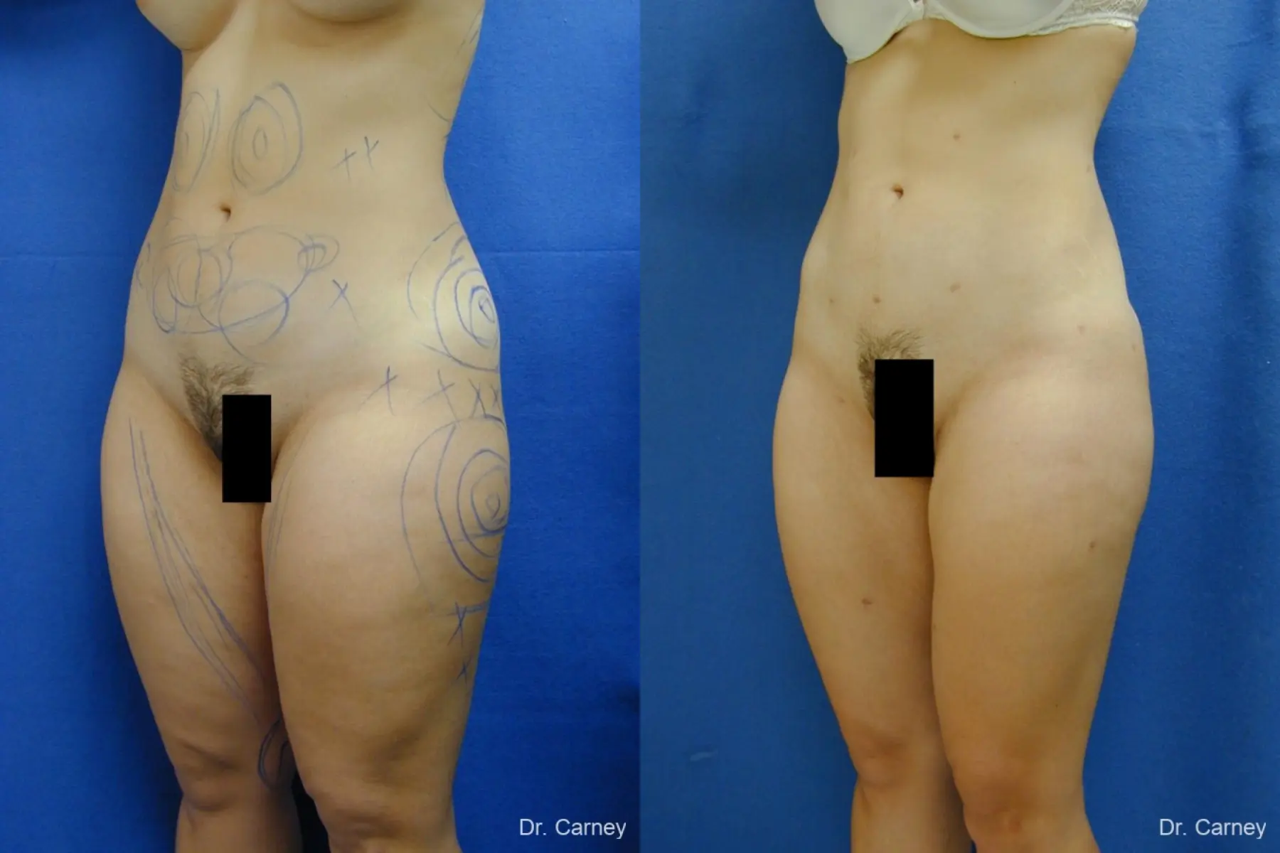 Virginia Beach Liposuction 1285 - Before and After 3