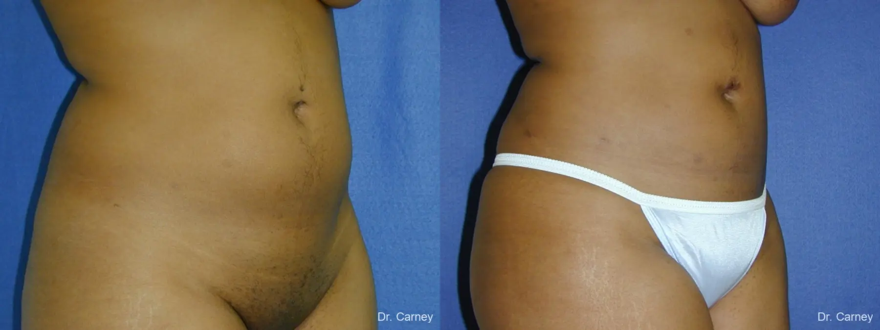 Virginia Beach Liposuction 1283 - Before and After 1