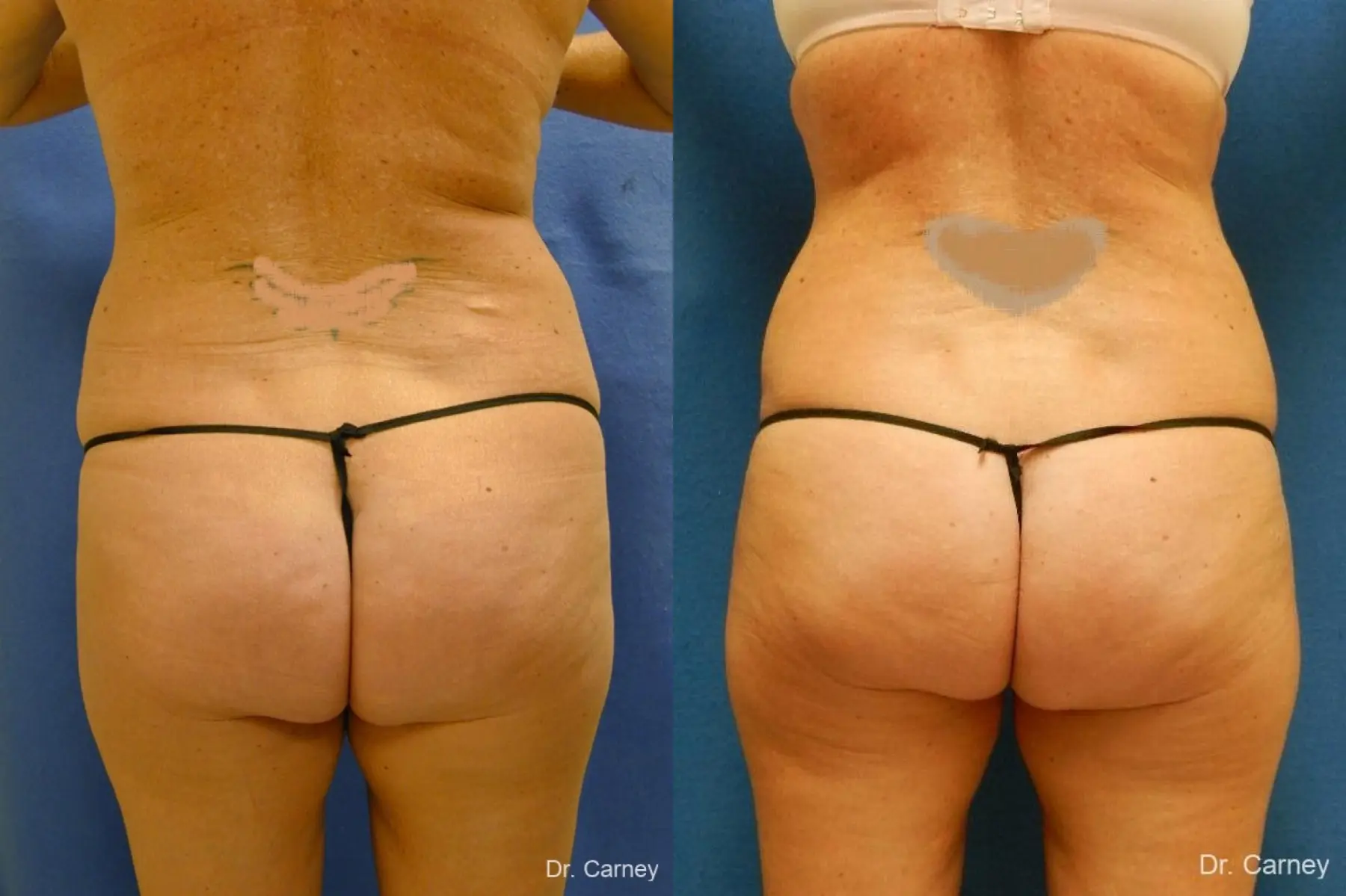 Virginia Beach Liposuction 1279 - Before and After 4
