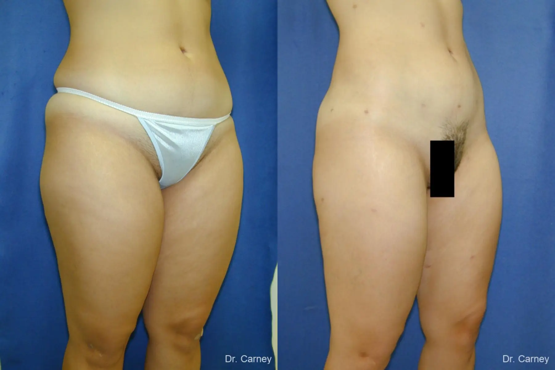 Virginia Beach Liposuction 1285 - Before and After 1