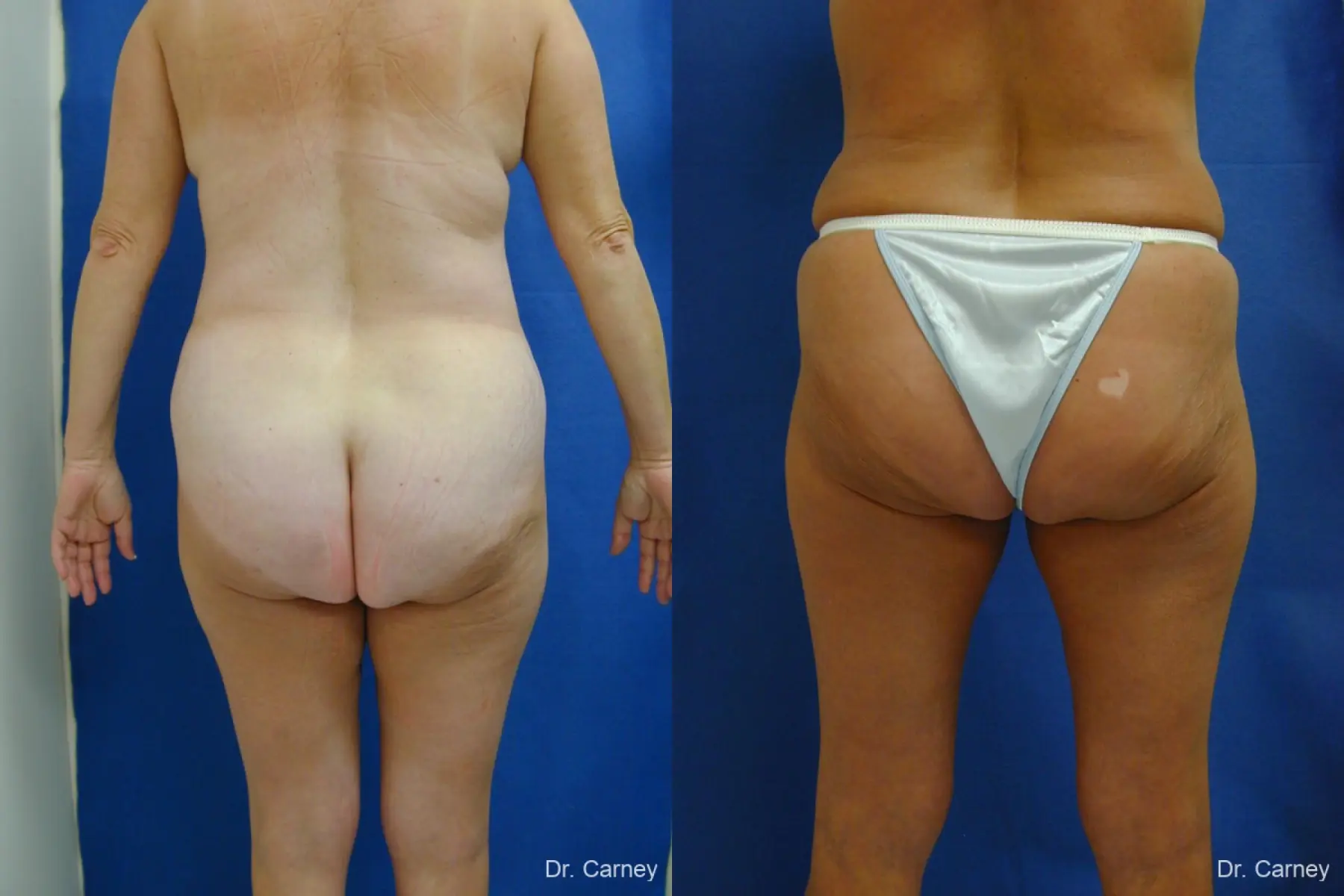 Virginia Beach Liposuction 1213 - Before and After 4