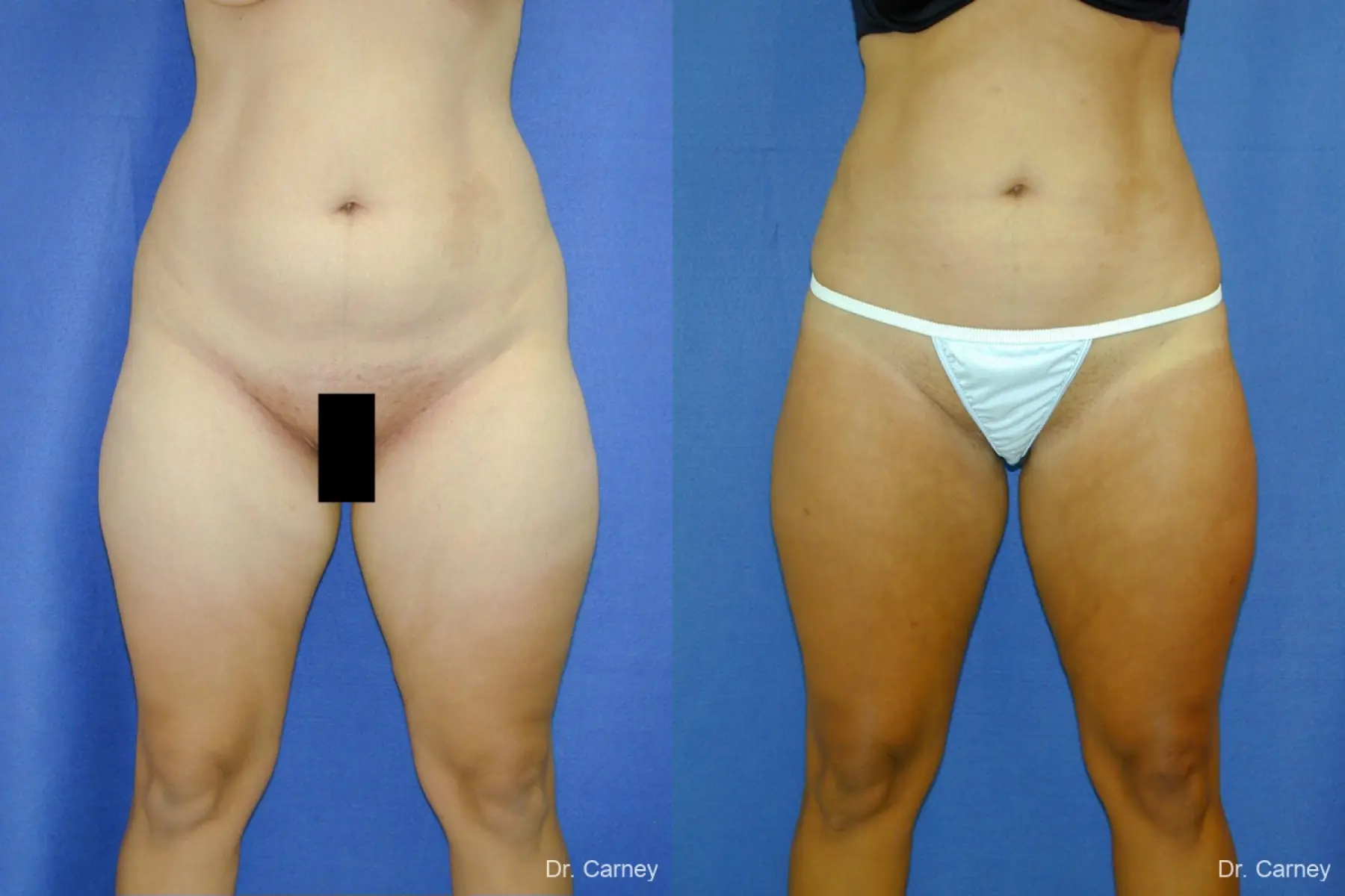 Virginia Beach Liposuction 1284 - Before and After 4