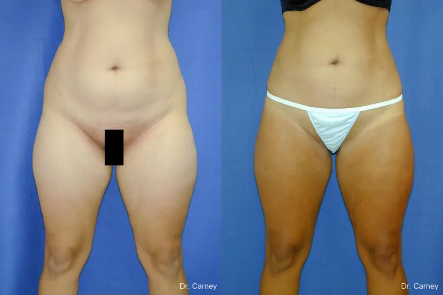 Virginia Beach Liposuction 1284 - Before and After 4