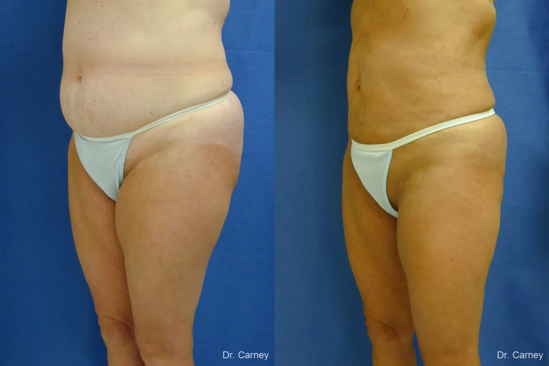 Virginia Beach Liposuction 1213 - Before and After