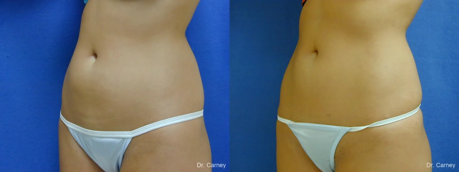 Virginia Beach Liposuction 1277 - Before and After 4