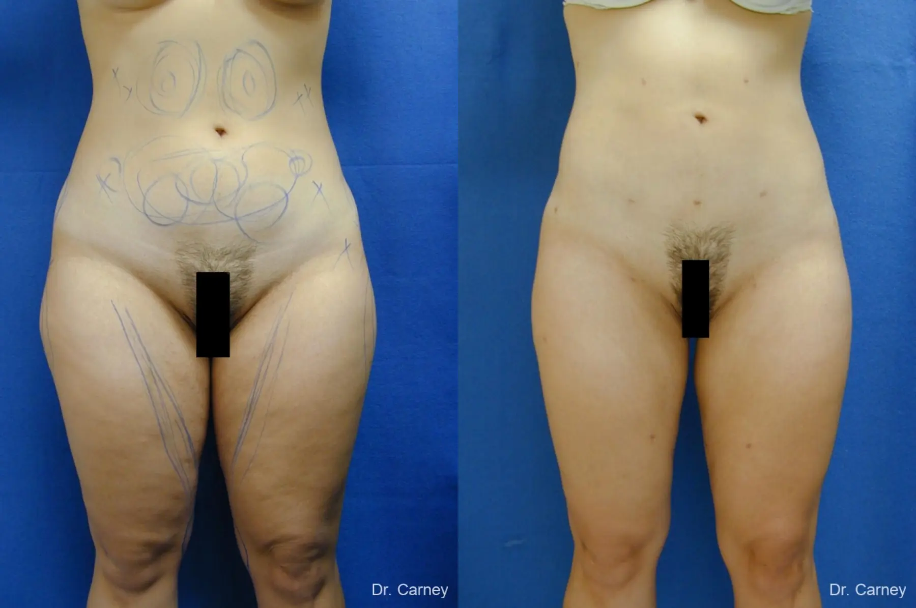Virginia Beach Liposuction 1276 - Before and After 4