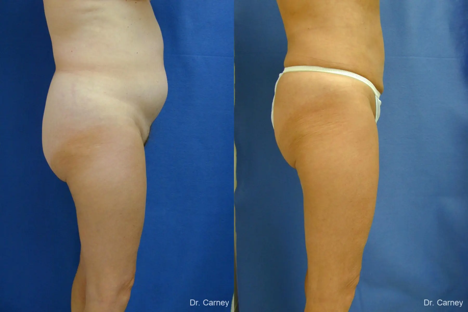 Virginia Beach Liposuction 1213 - Before and After 5