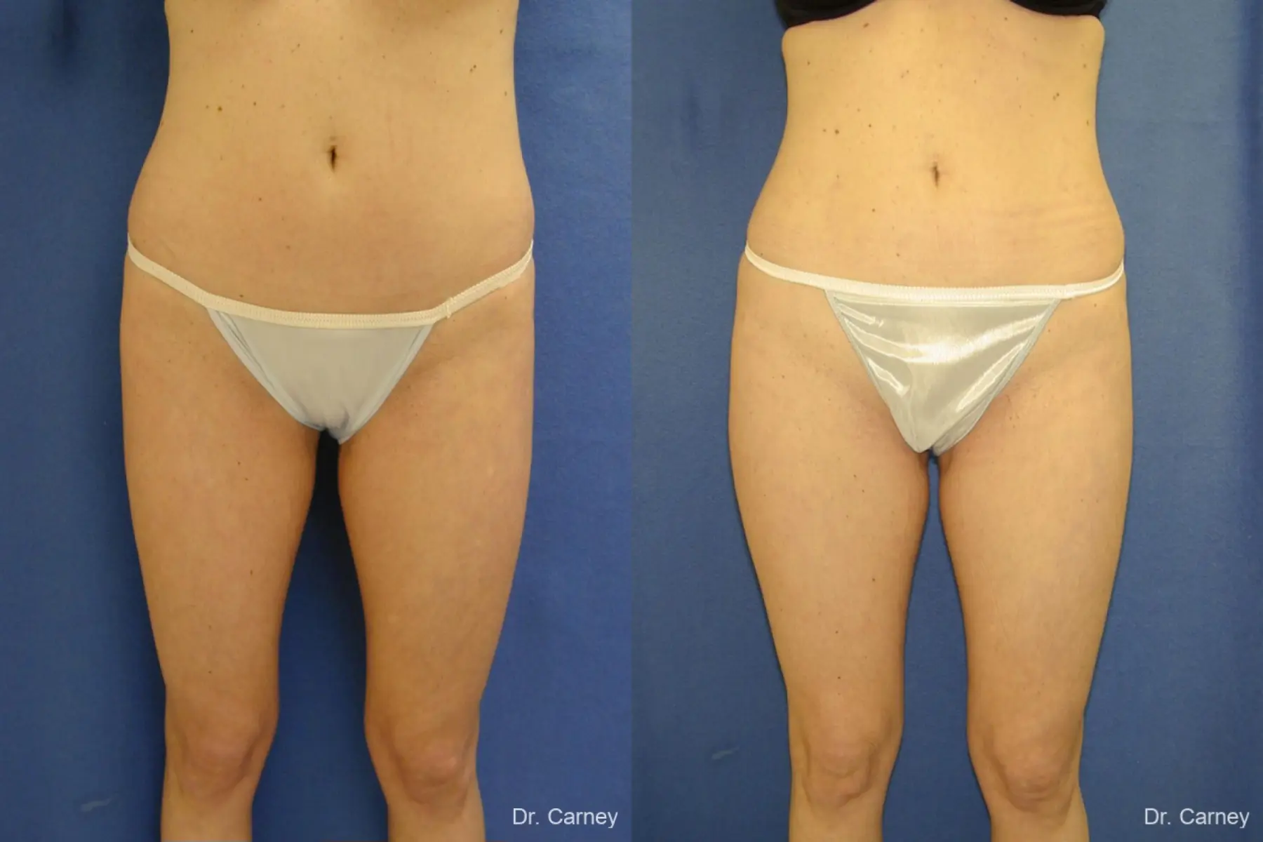 Virginia Beach Liposuction 1280 - Before and After 1