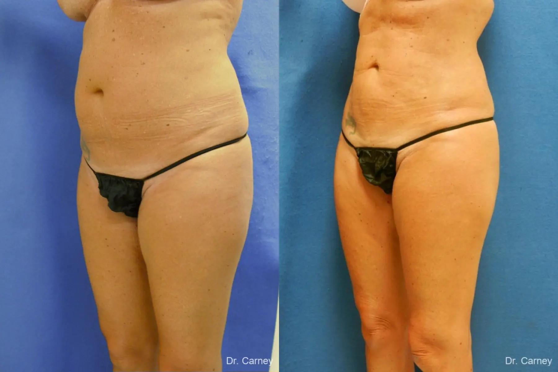 Virginia Beach Liposuction 1279 - Before and After 3