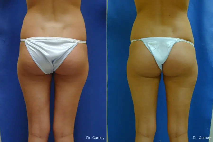 Virginia Beach Liposuction 1277 - Before and After 3