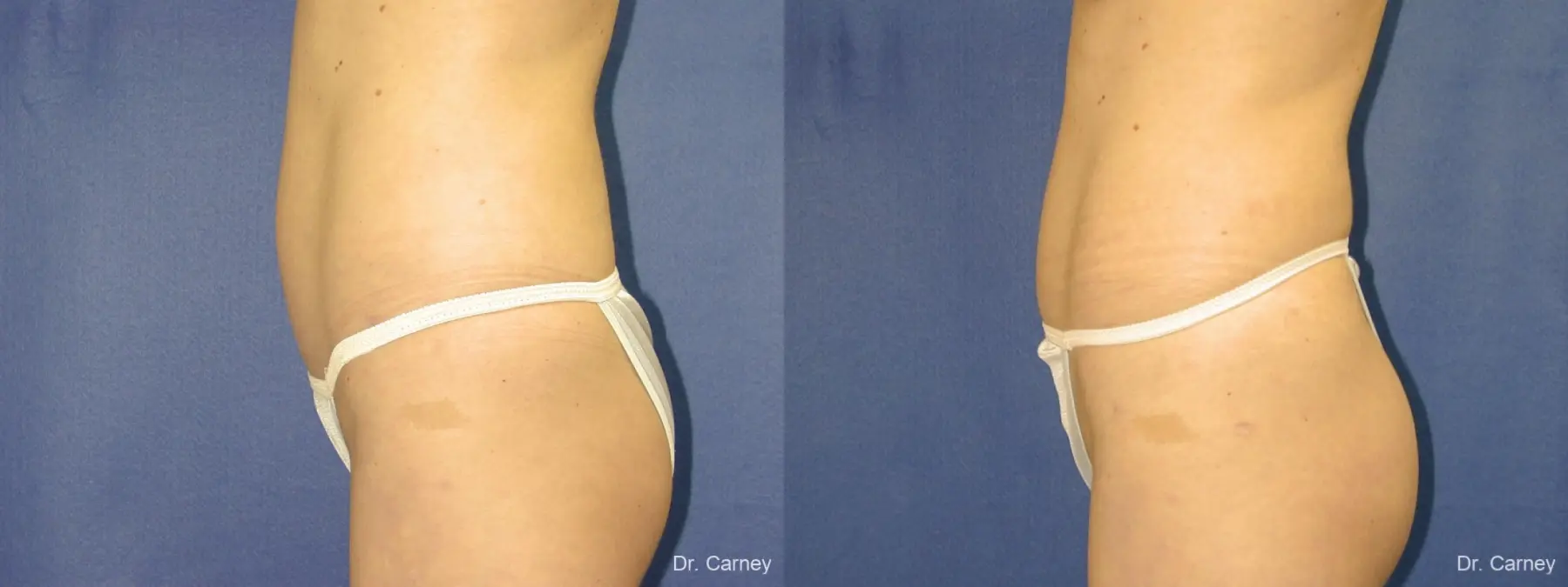 Virginia Beach Liposuction 1280 - Before and After 3