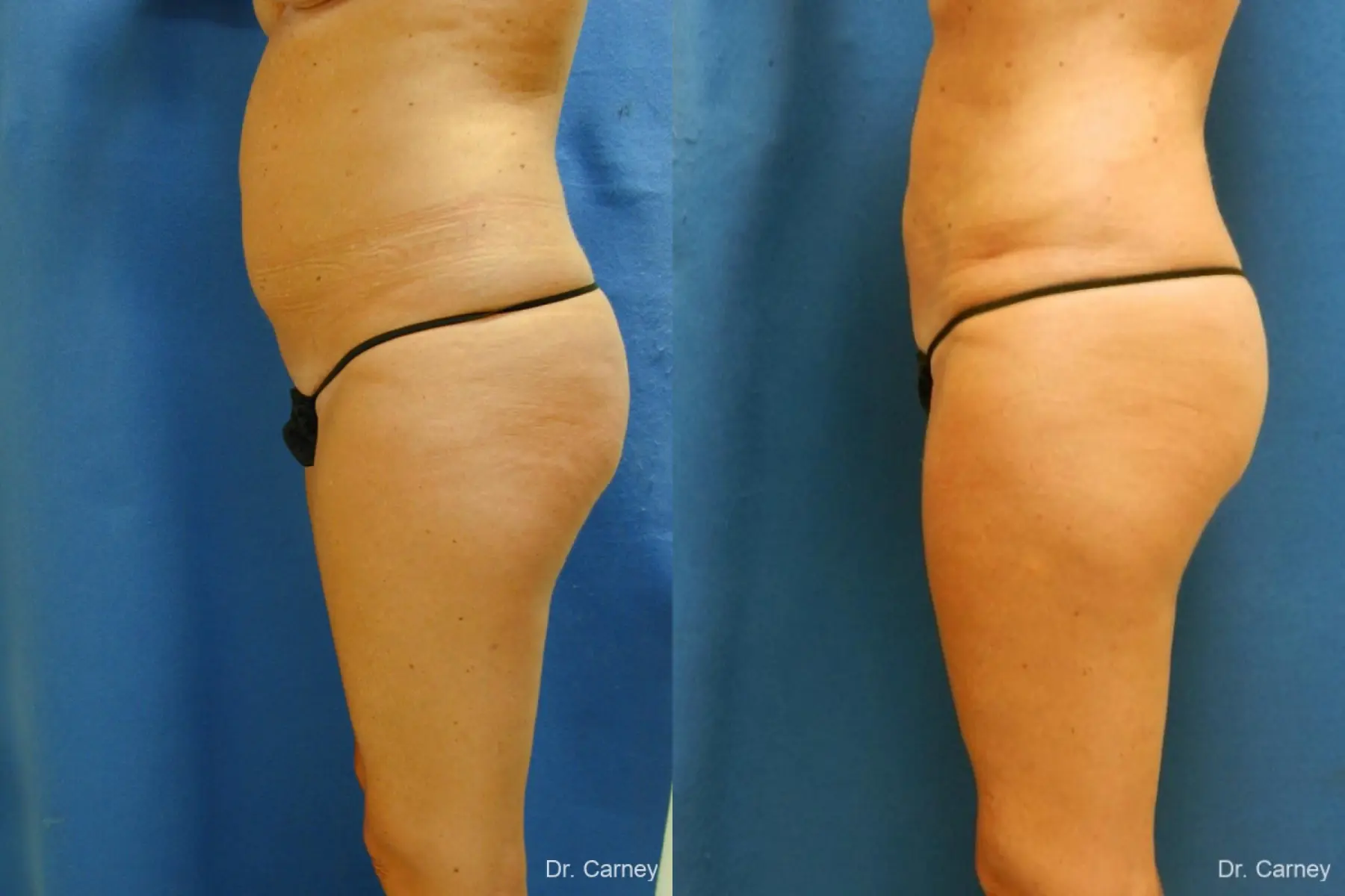 Virginia Beach Liposuction 1279 - Before and After 5