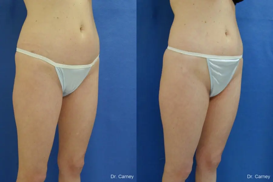 Virginia Beach Liposuction 1280 - Before and After 5