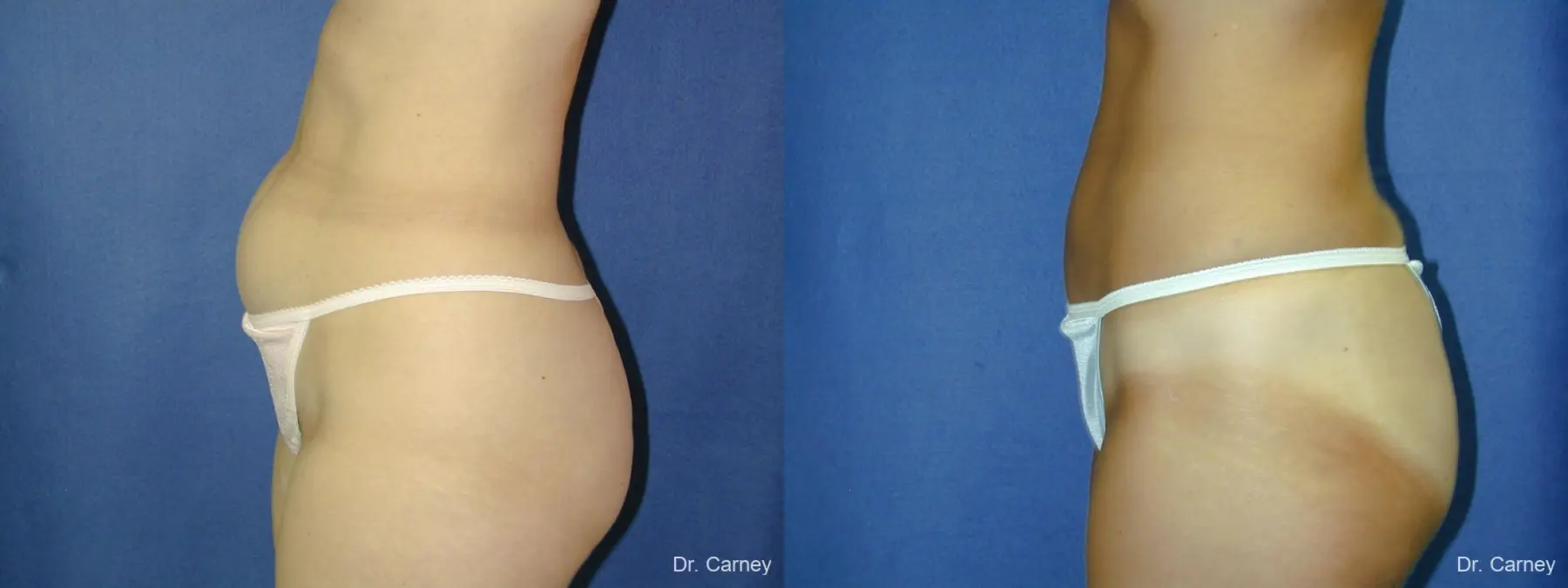 Virginia Beach Liposuction 1282 - Before and After 5