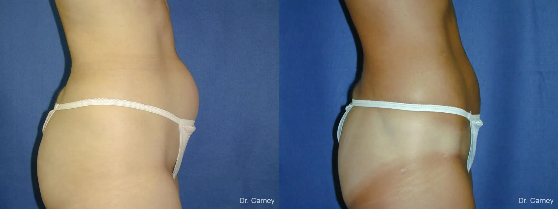 Virginia Beach Liposuction 1282 - Before and After 3
