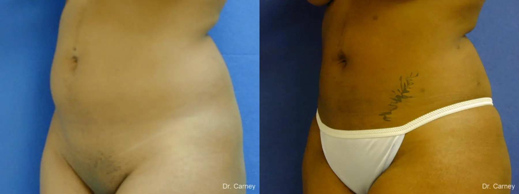 Virginia Beach Liposuction 1283 - Before and After 3