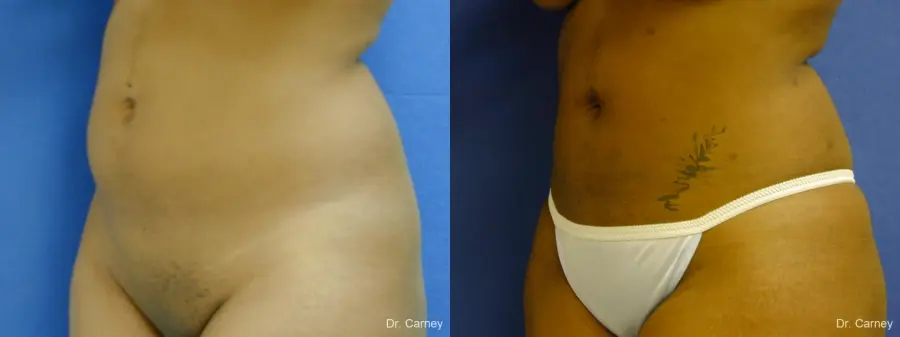 Virginia Beach Liposuction 1283 - Before and After 3