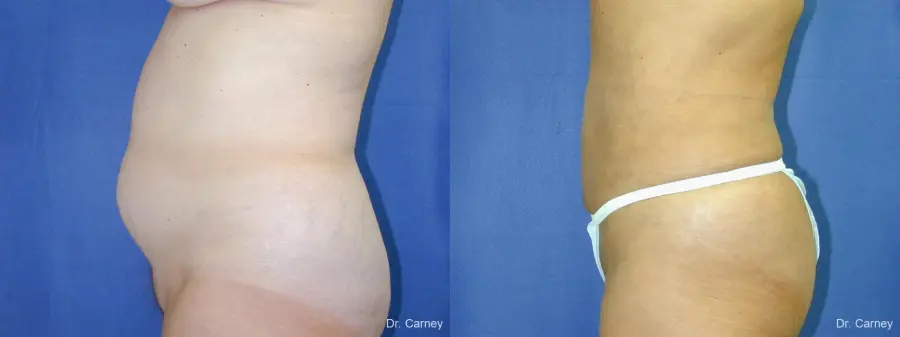 Virginia Beach Liposuction 1213 - Before and After 2
