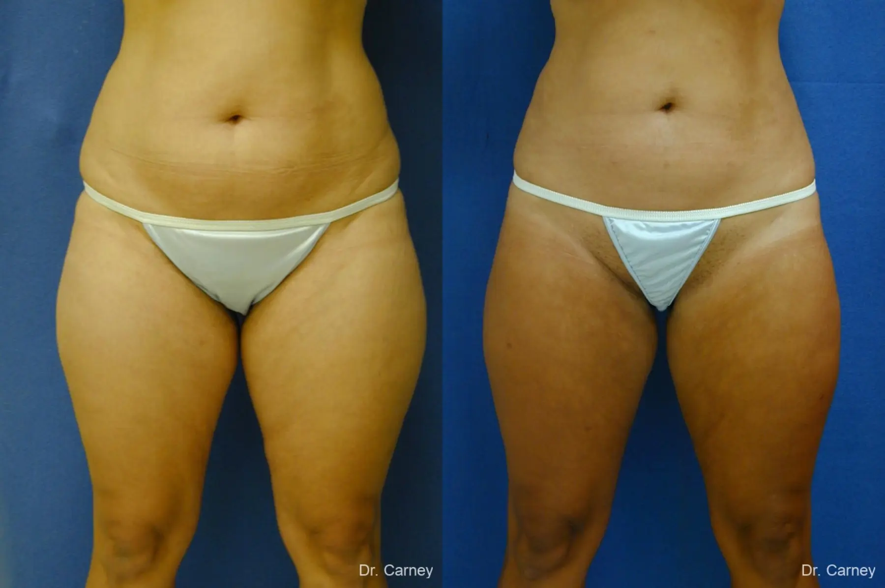 Virginia Beach Liposuction 1284 - Before and After 1