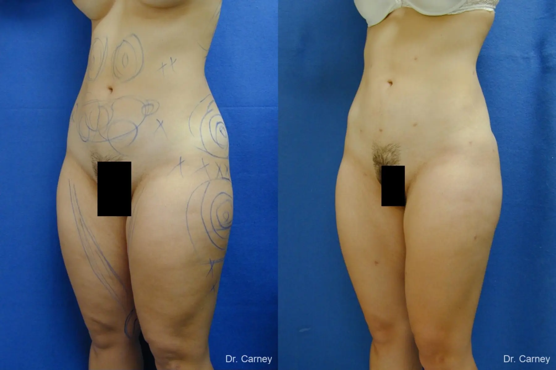 Virginia Beach Liposuction 1276 - Before and After 5