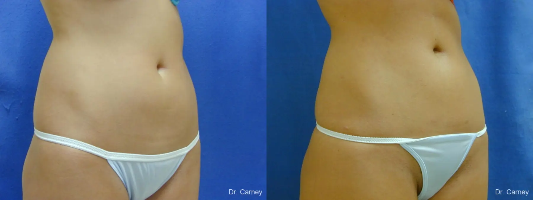 Virginia Beach Liposuction 1277 - Before and After 2
