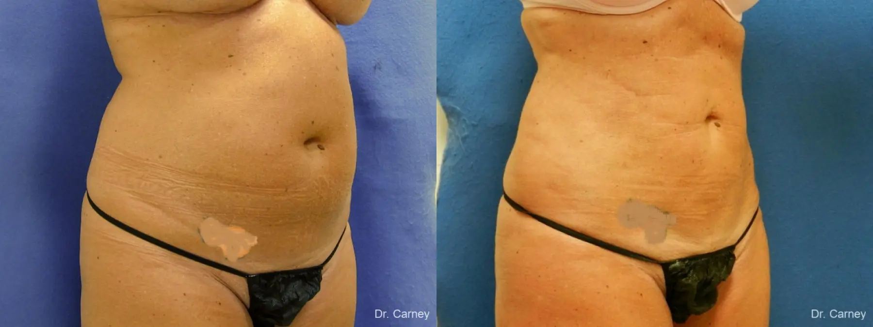 Virginia Beach Liposuction 1279 - Before and After 1