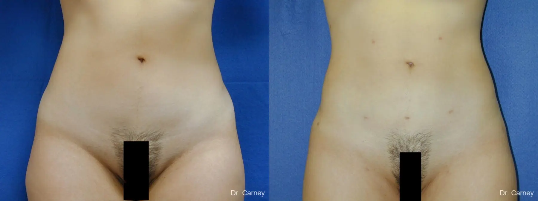 Virginia Beach Liposuction 1276 - Before and After 1