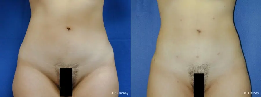 Virginia Beach Liposuction 1276 - Before and After 1