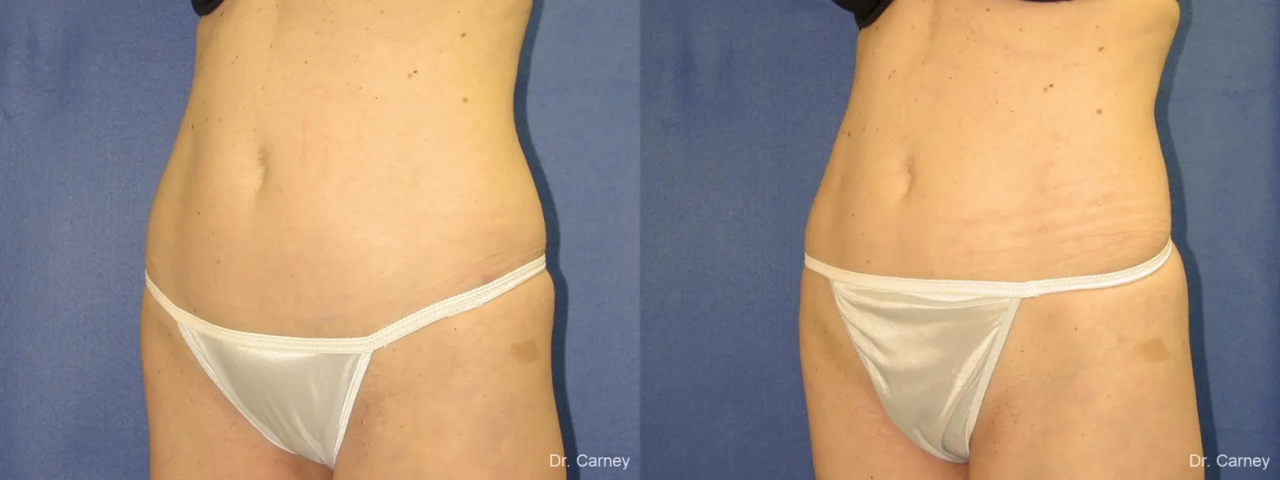 Virginia Beach Liposuction 1280 - Before and After 2