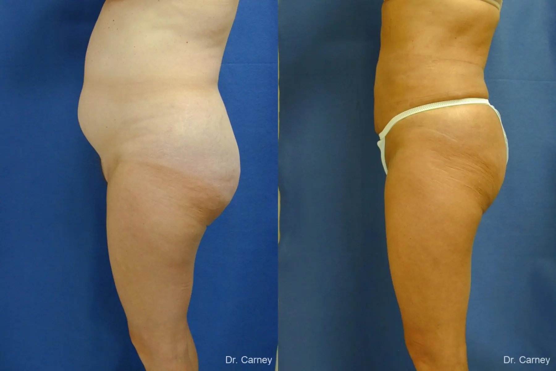 Virginia Beach Liposuction 1213 - Before and After 3