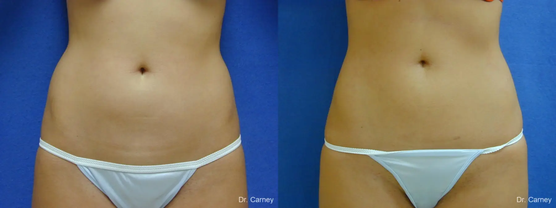 Virginia Beach Liposuction 1277 - Before and After 1
