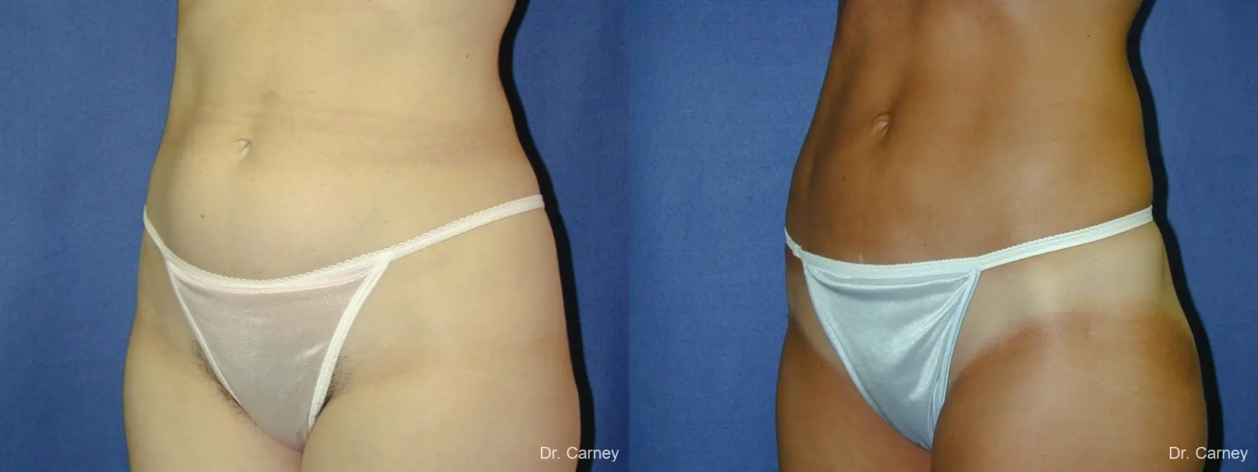 Virginia Beach Liposuction 1282 - Before and After 4