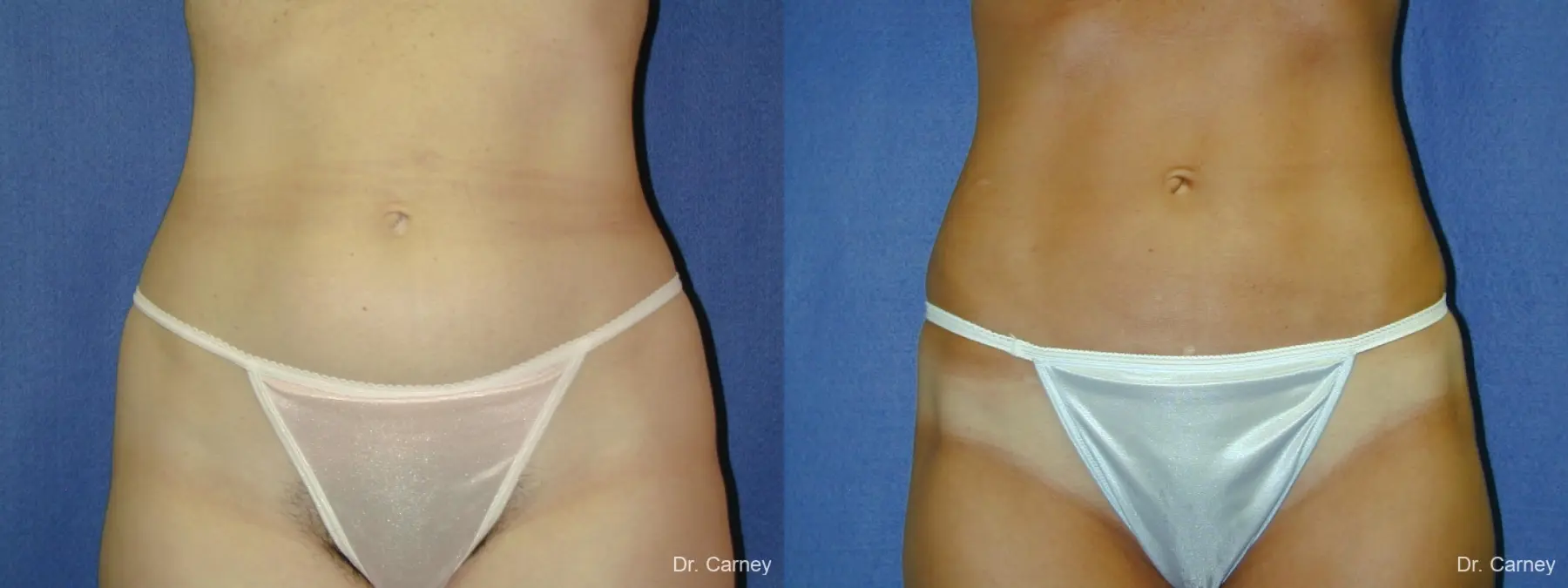 Virginia Beach Liposuction 1282 - Before and After