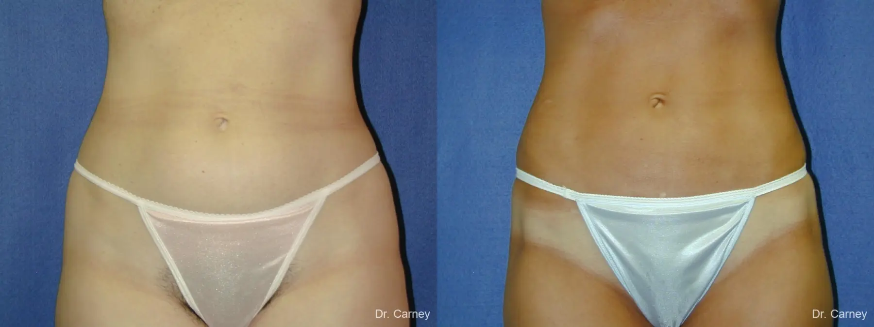 Virginia Beach Liposuction 1282 - Before and After 1