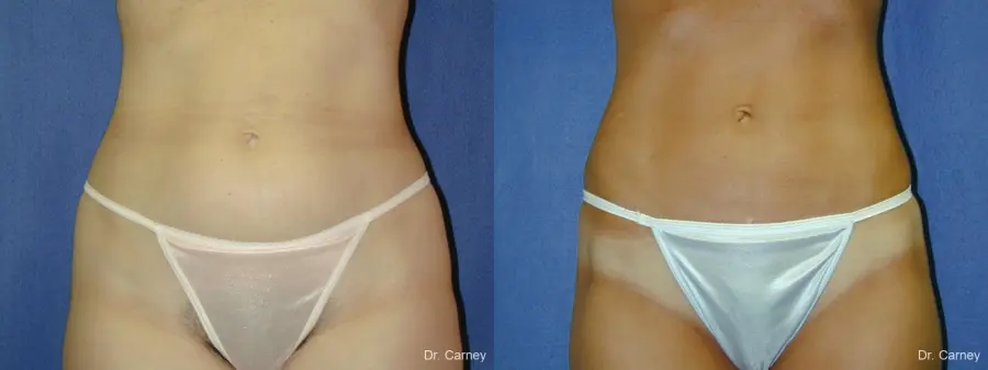 Virginia Beach Liposuction 1282 - Before and After 1
