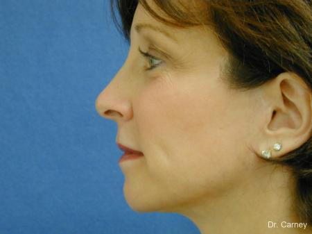 Virginia Beach Brow Lift 1217 - After Image 3