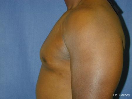 Virginia Beach Gynecomastia 1226 - After Image 5