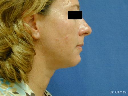 Virginia Beach Neck Lift 1267 - After Image 1