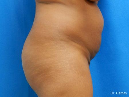 Abdominoplasty: Patient 1 - Before Image 1