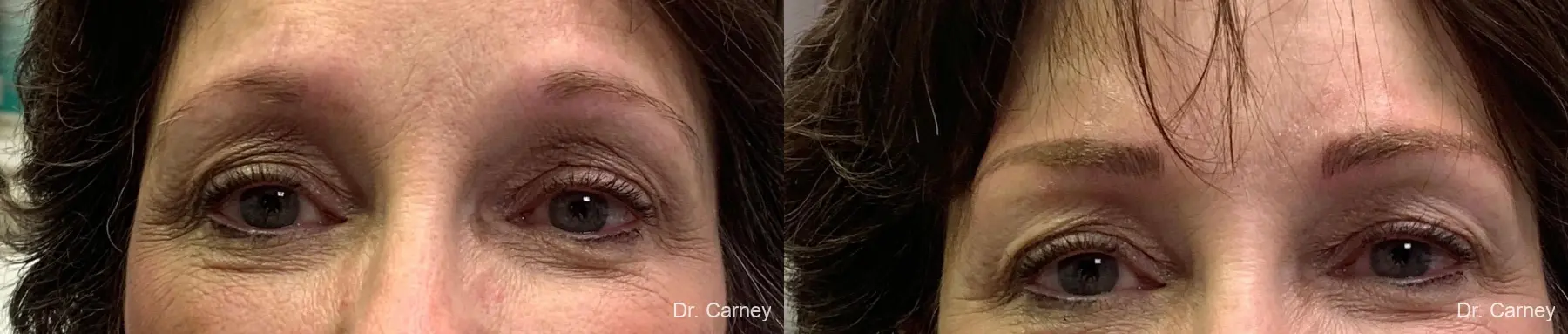 Microblading: Patient 3 - Before and After 1