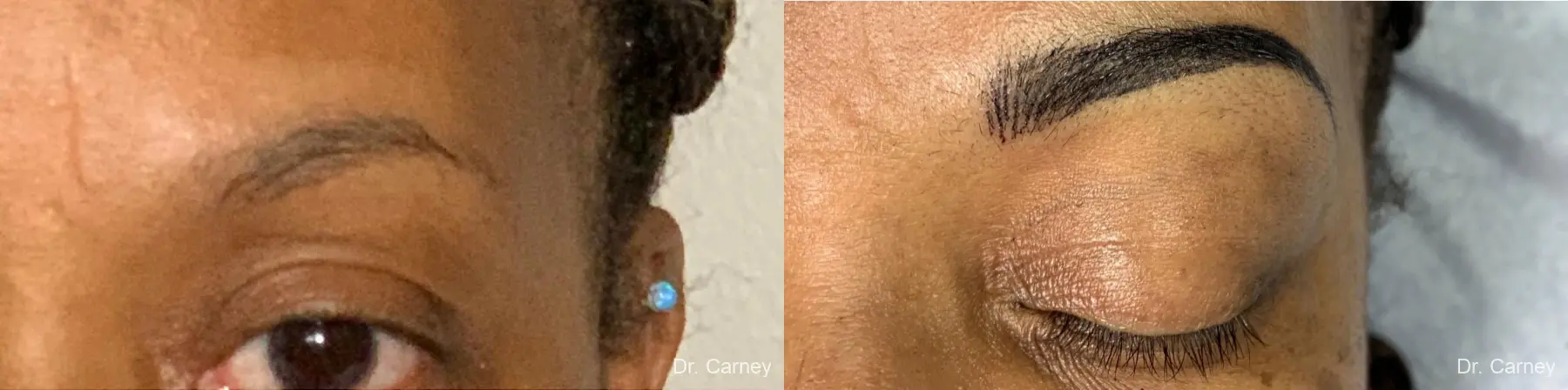 Microblading: Patient 2 - Before and After 1