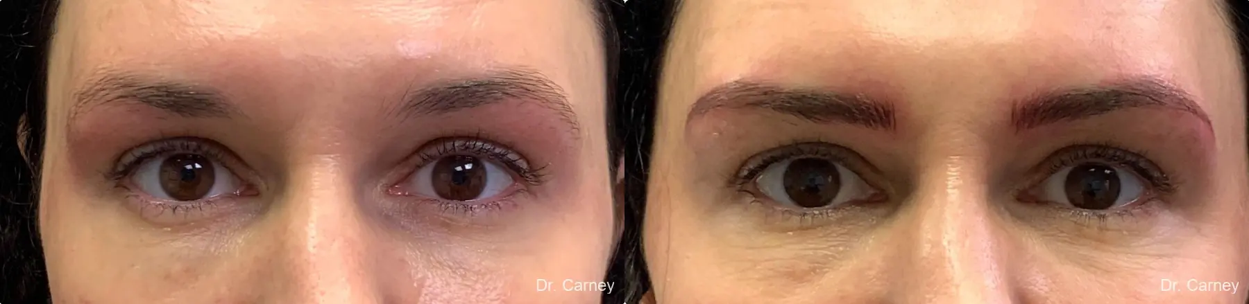 Microblading: Patient 1 - Before and After  