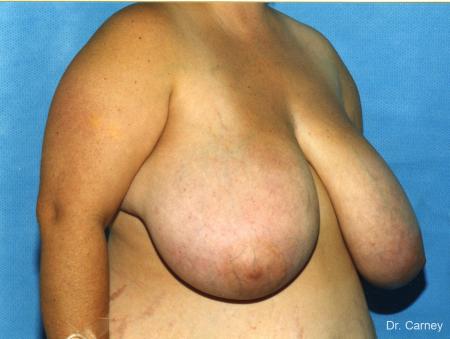Virginia Beach Breast Reduction 1232 - Before Image 1