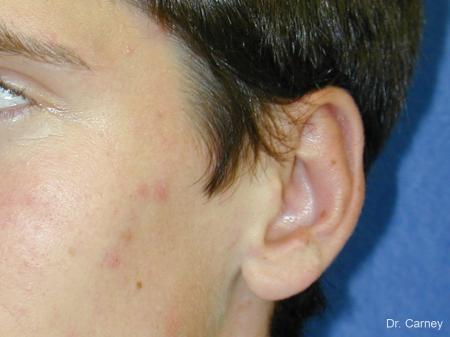 Virginia Beach Otoplasty Earlobe Repair 1271 - After Image 3